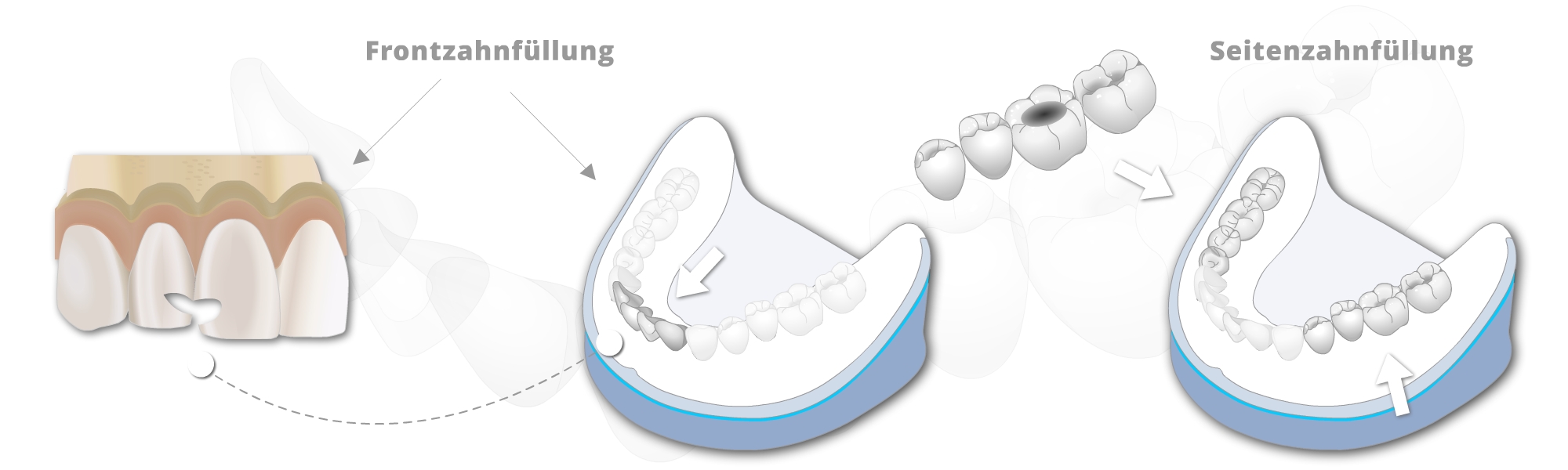 Illustration von verschiedenen Modellen mit Füllungstherapien