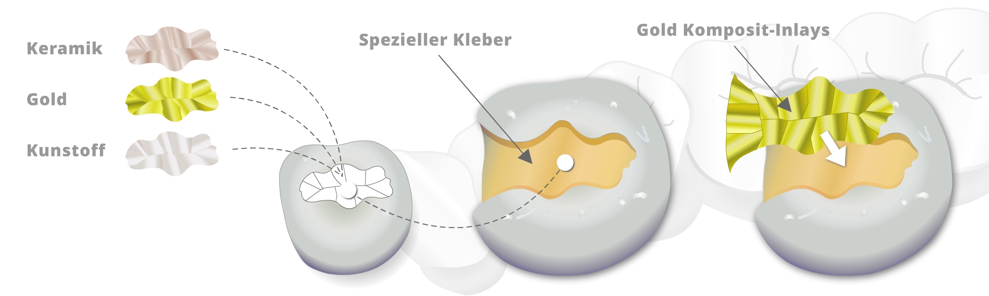 Illustration von Inlays an Modellen