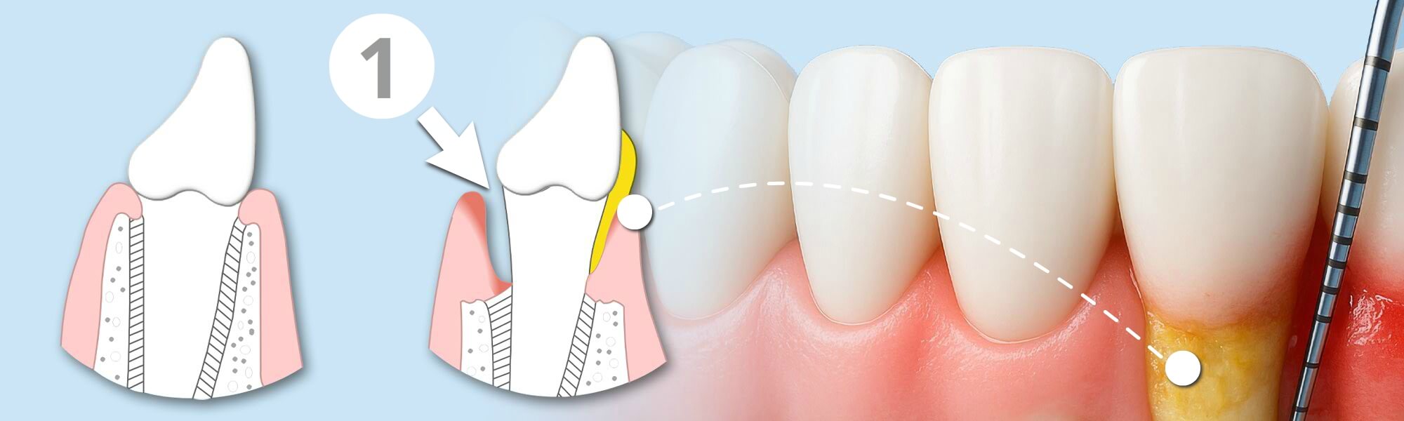 Illustration der Parodontalbehandlung: links Diagramm mit zurückgezogenem Zahnfleisch und Entzündung, rechts echte Zahnaufnahme mit gelbem Belag am Zahnhals.