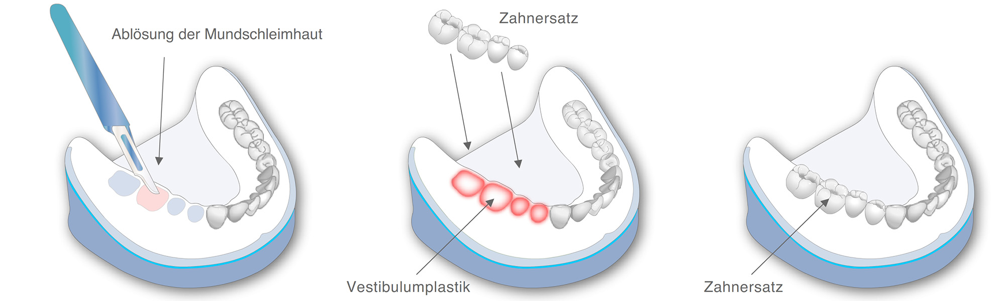 Grafische Darstellung der präprothetischen Chirurgie im Unterkiefer: Ablösen der Mundschleimhaut, rot markierte Operationsbereiche und abschließende Darstellung mit eingesetztem Zahnersatz