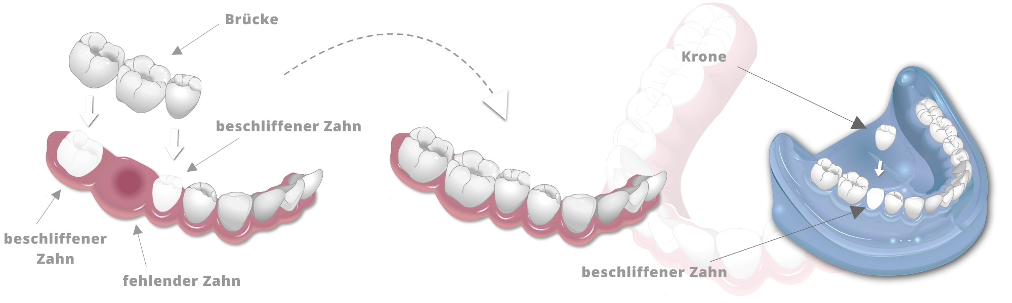 Darstellung von Einsetzen einer vollkeramikkronenbrücke sowie eine Krone auf einem beschliffenen Zahn