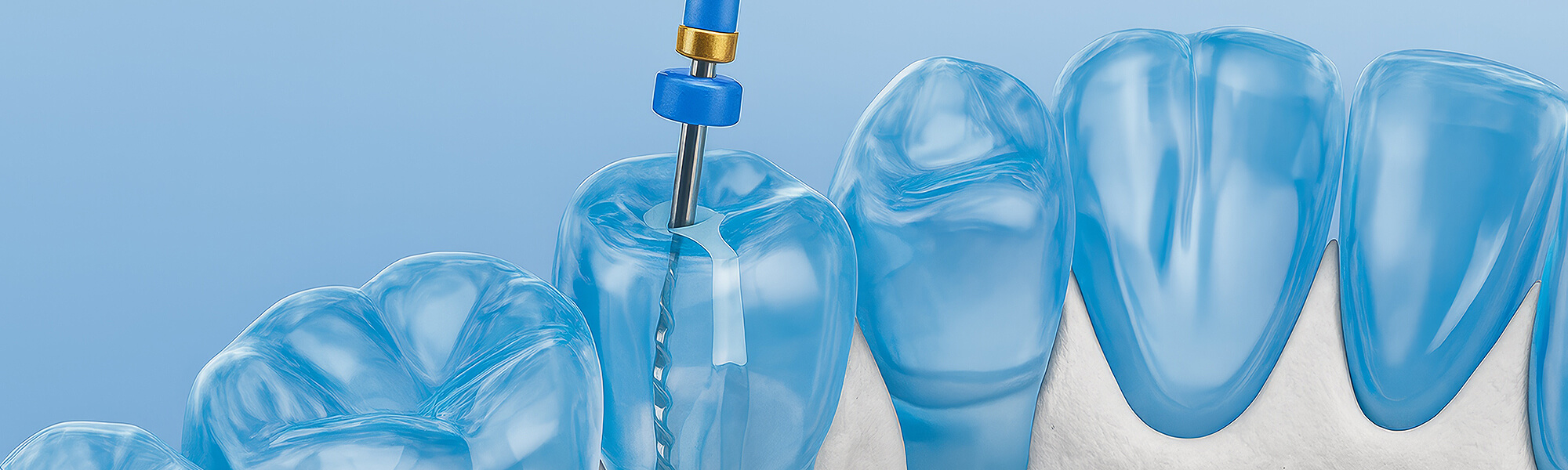 Illustration eines Kiefermodells, darstellung einer Wurzelbehandlung