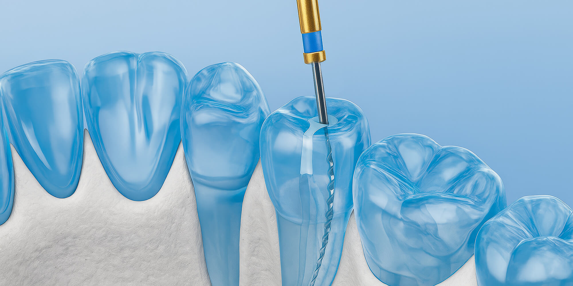 Grafische Darstellung einer Wurzelbehandlung: Zahn im Querschnitt mit eingesetzter Feile zur Reinigung des Wurzelkanals.