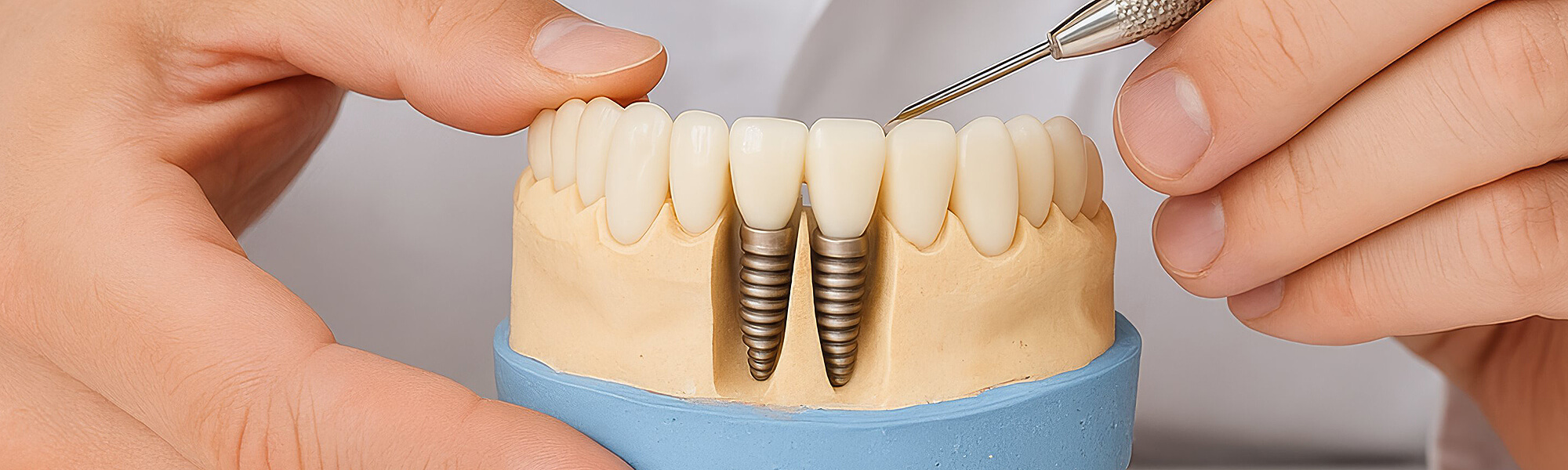 Modell eines Gebisses mit zwei eingesetzten Implantaten, gehalten und untersucht mit zahnärztlichem Werkzeug.