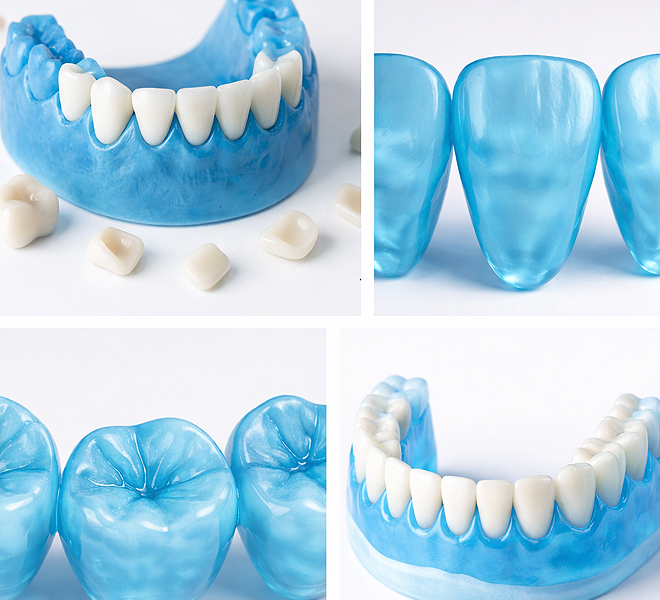 Zahnmodell mit eingesetzten Keramikkronen sowie Detailansichten einzelner Zähne zur Darstellung von Zahnersatz und Formgebung.