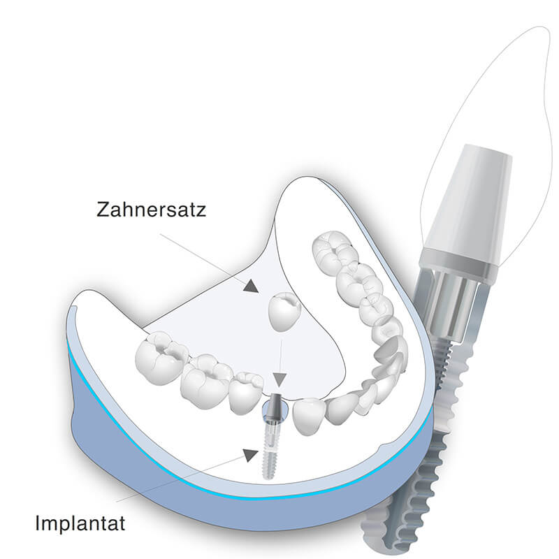 Vorschaubild - Behandlungsmethode Einzelzahnversorgung als Illustration
