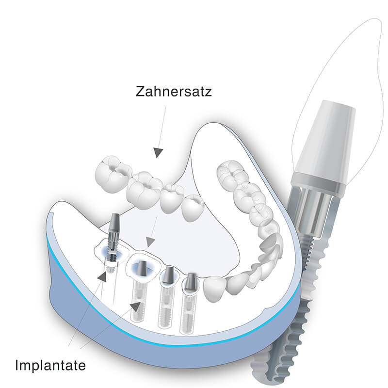 Vorschaubild - Behandlungsmethode der Verkürzten Zahnreihe
