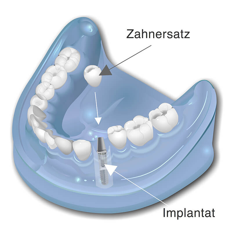 Implantatgetragener Zahnersatz