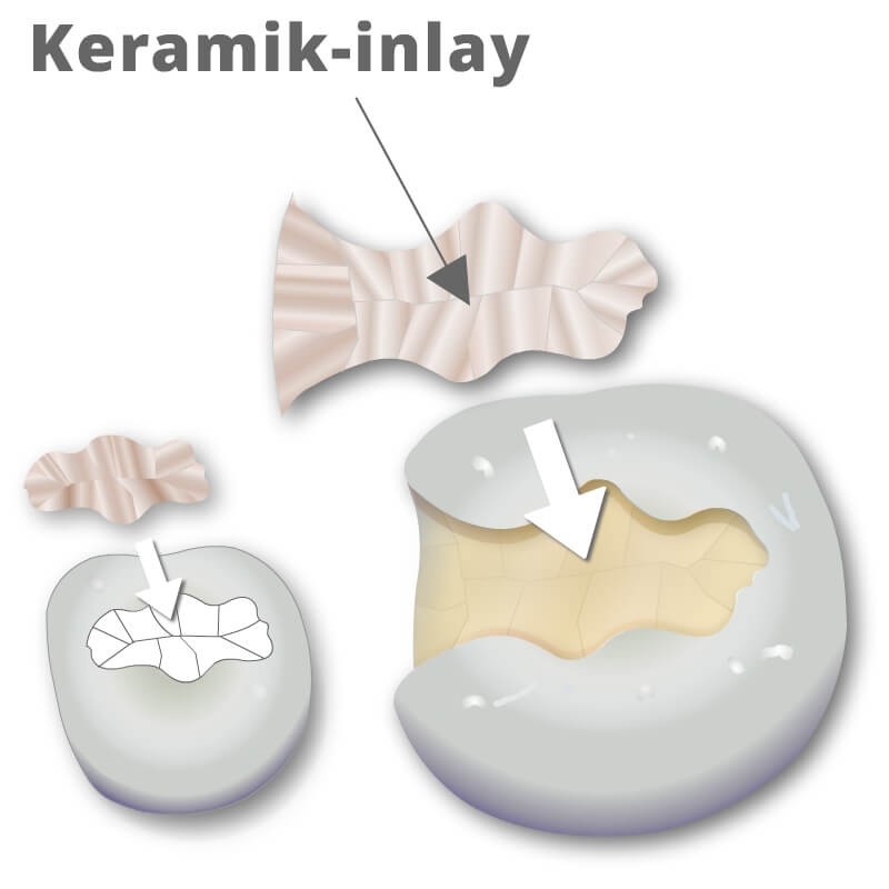 Vorschau Bild einer Behandlungsanimation von Keramik Inlays, Modellansicht