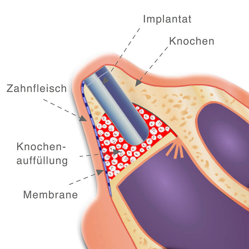 Illustration Vorschaubild - Animation einer Zystenentfernung