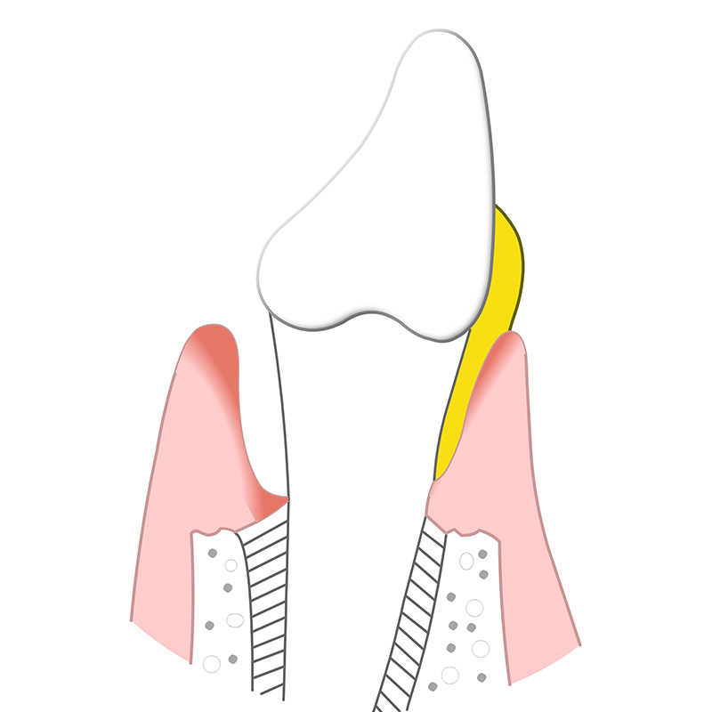 Animation von Entzündetem Zahnfleisch, das anschwillt, sich vom Zahn löst und zum Abbau des Kieferknochens führt.