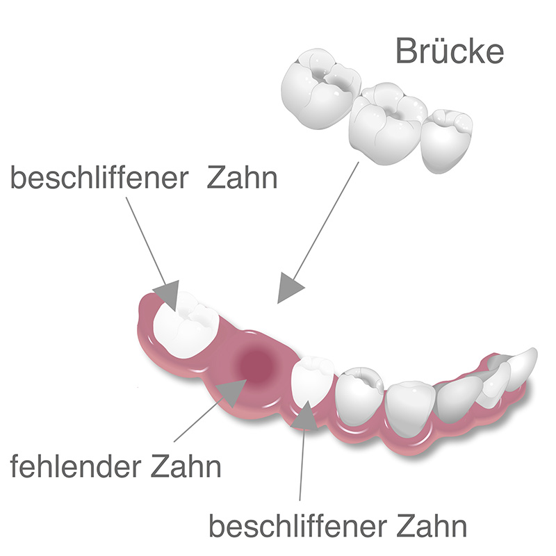 Vollkeramischekronen