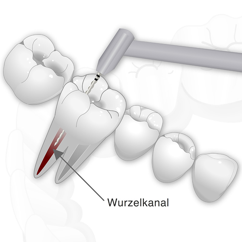 Vorschaubild einer Animation die eine Wurzelbehandlung zeigt