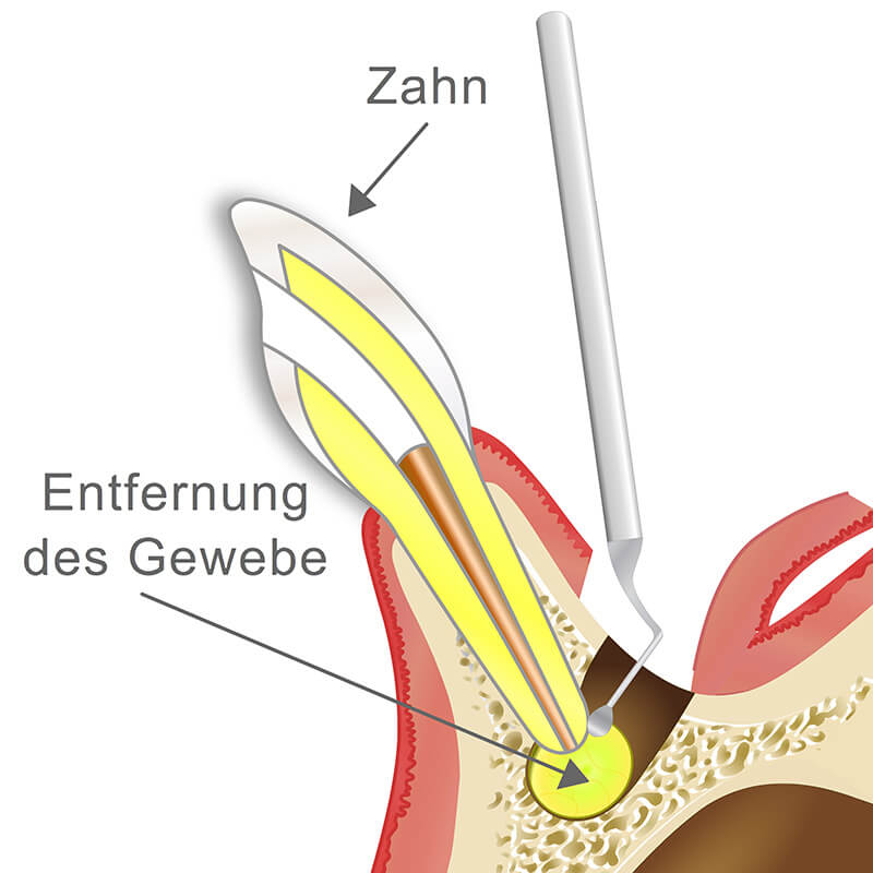 Illustration Vorschaubild - Animation Wurzelspitzenresektion